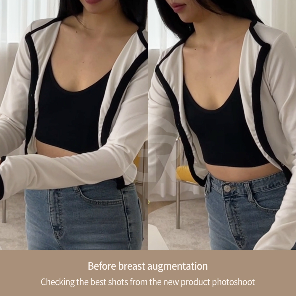 For patients with slim body types, choosing the correct implant size and projection is important to achieve natural-looking results.