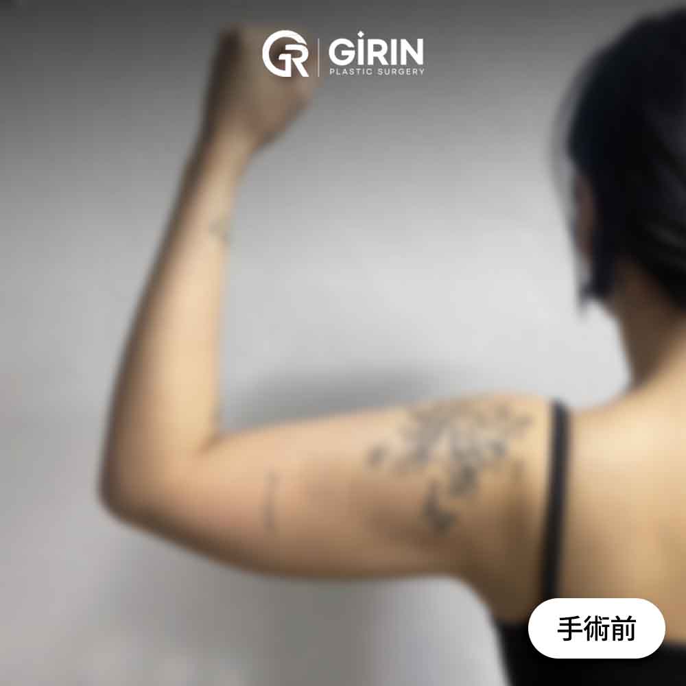 二の腕脂肪吸引後の回復過程