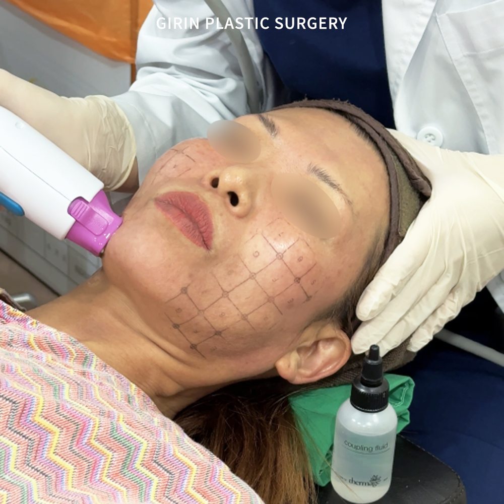 Thermage FLX отзывы иностранцев