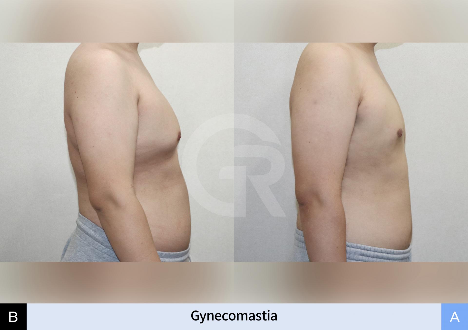 gland-removal-korean-clinic.jpg (2).jpg