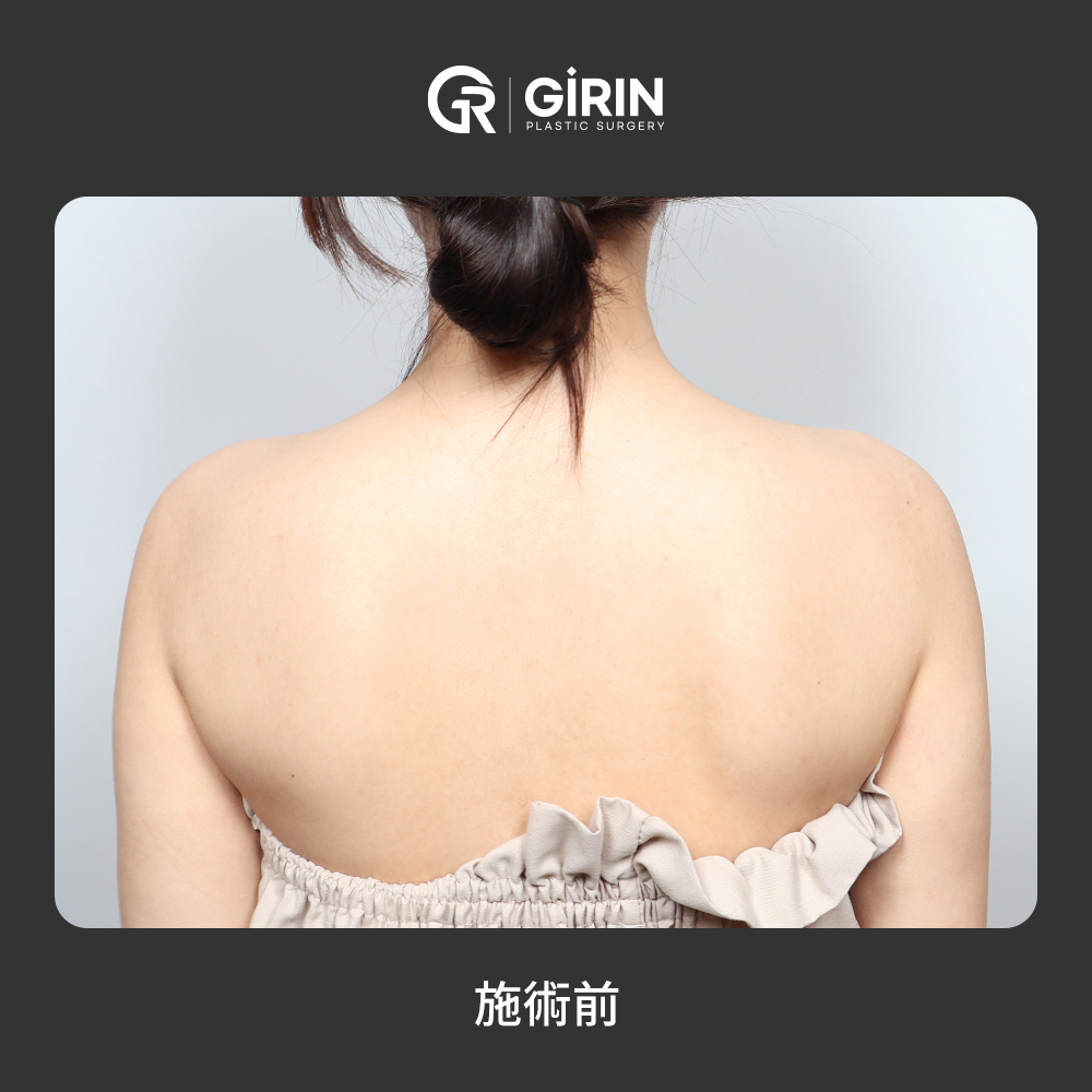 フィラー注入直後の腫れも最小限