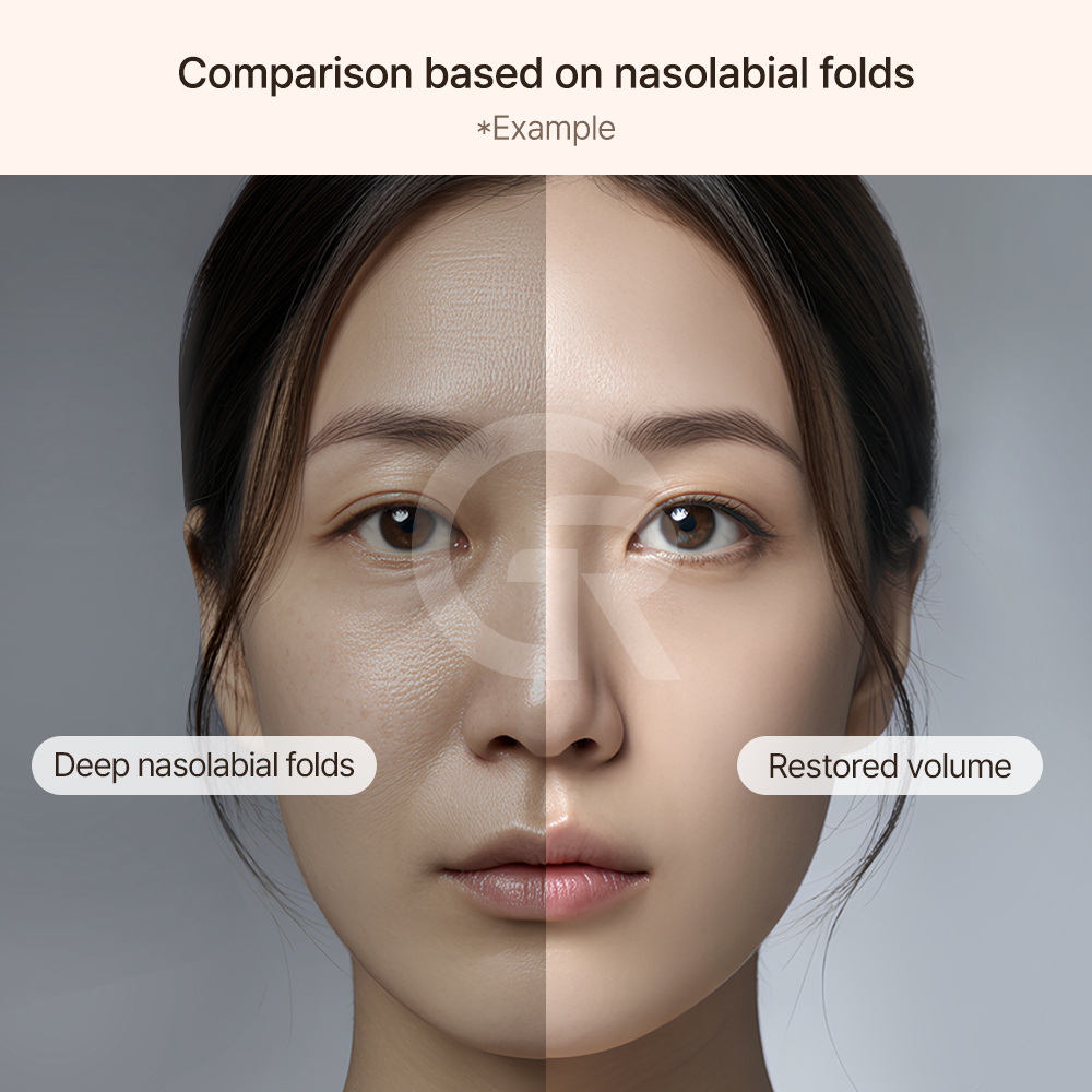 Paranasal augmentation improves midface projection and reduces the appearance of nasolabial folds in a natural way.
