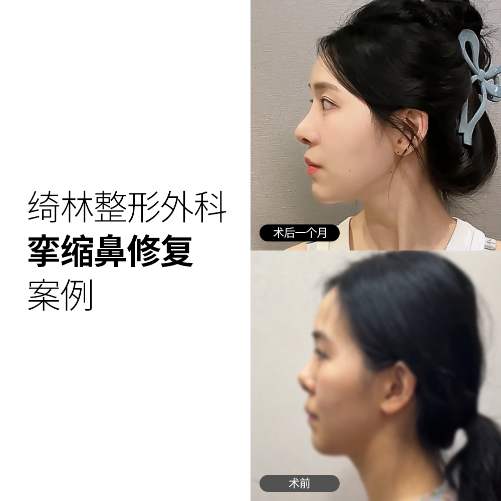 绮林整形外科鼻部重建案例