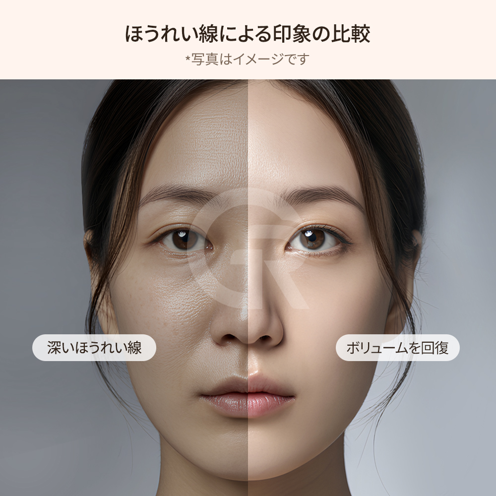 鼻翼基部増大術の前後比較と中顔面の自然な改善