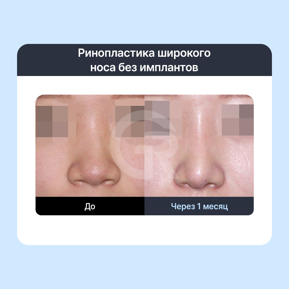Собственный реберный хрящ может быть полезен при повторной ринопластике или структурной реконструкции носа.