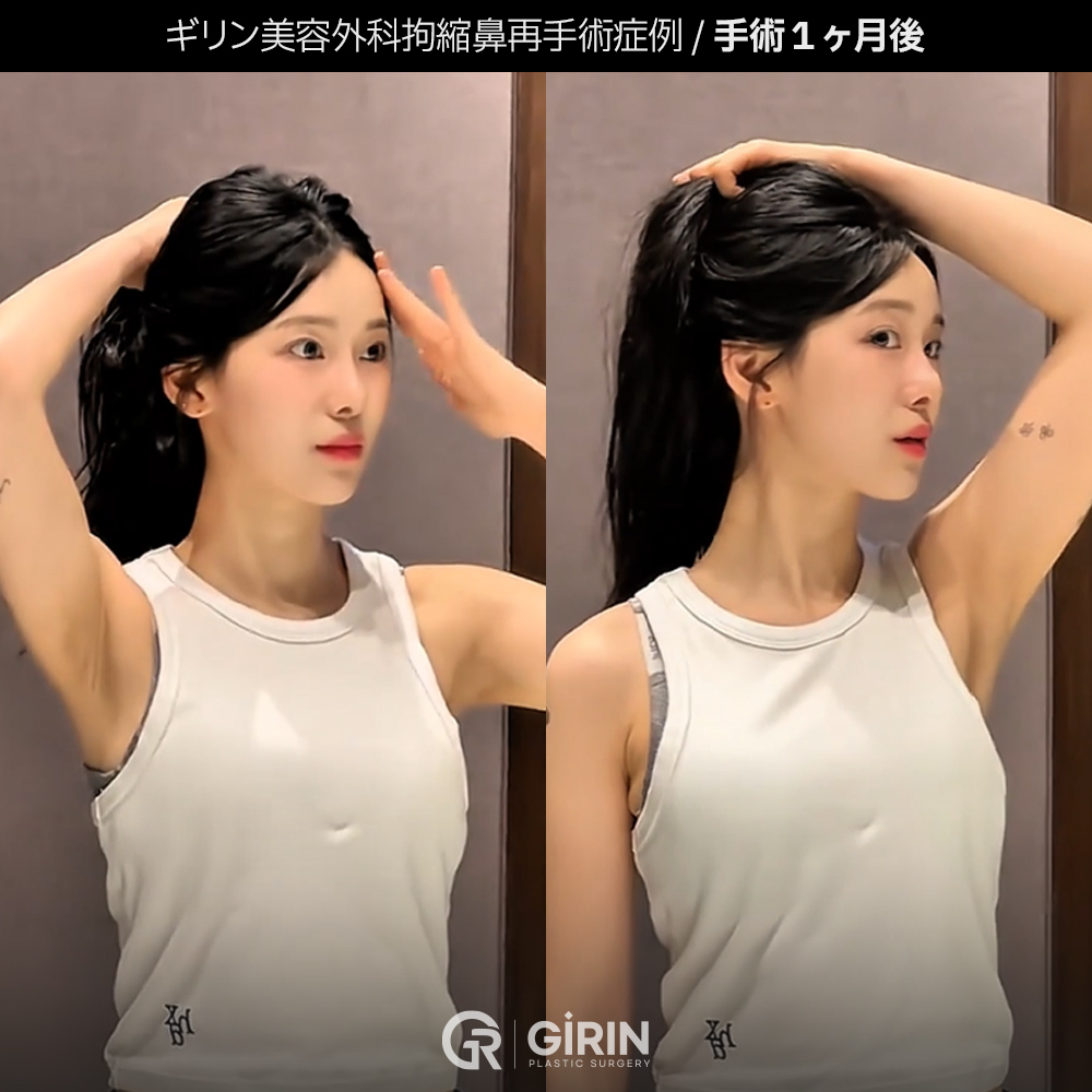 ソウルでの鼻再手術カウンセリングの様子