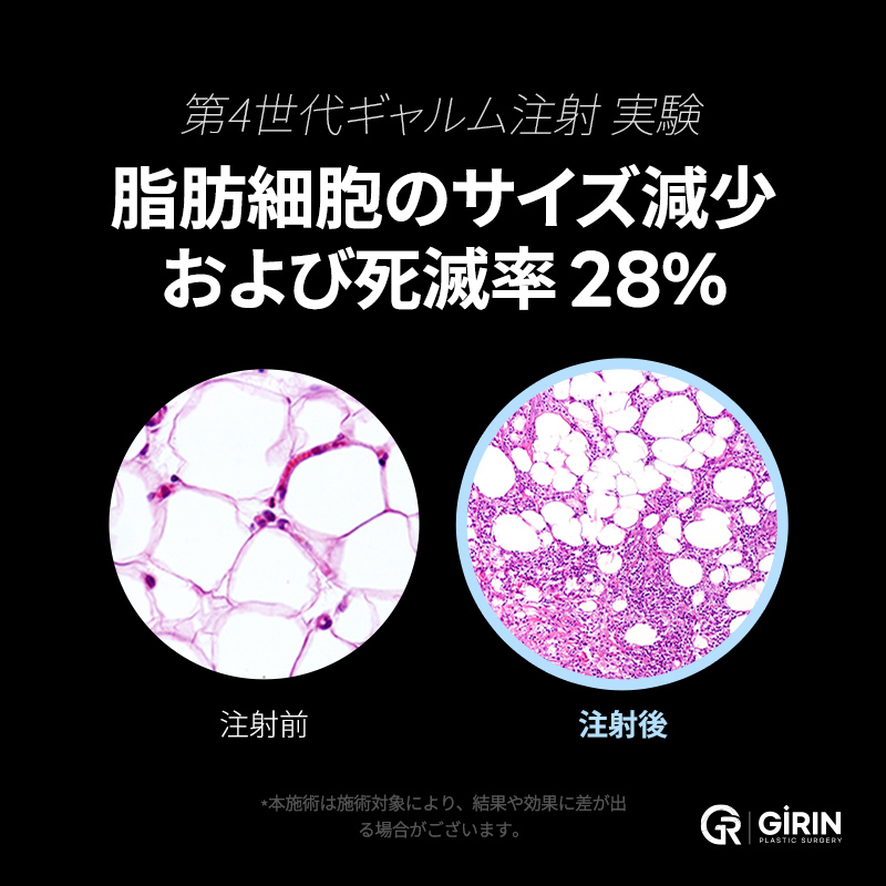 길린의 작은 얼굴 주사로 지방을 분해하고 깔끔한 얼굴 라인에脂肪溶解注射で下あごの脂肪を減らし、自然な小顔効果