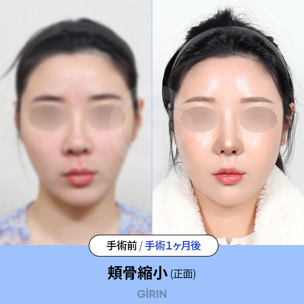 韓国は自然で上品な輪郭整形に強みがあります。