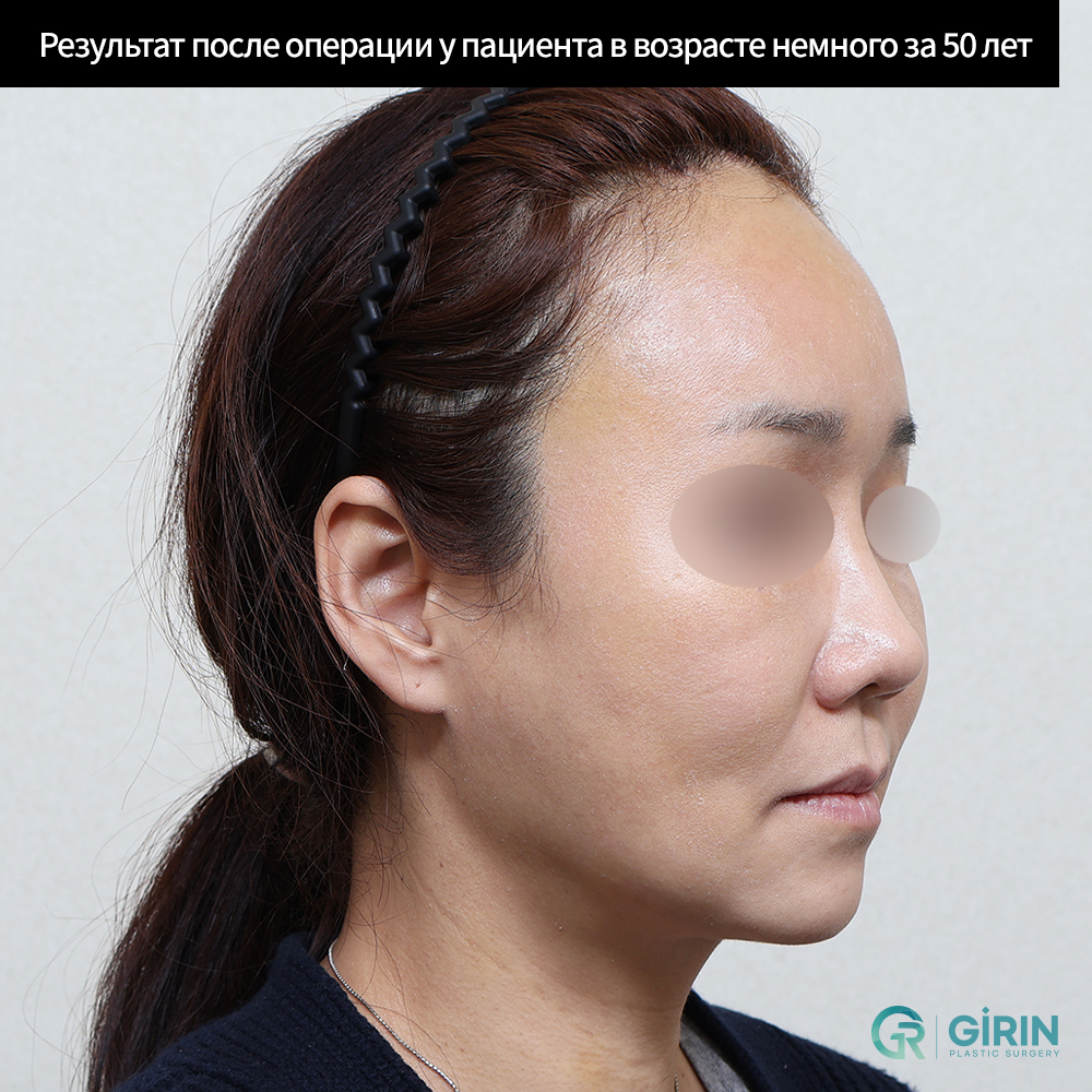 Эффективное устранение щечных провисаний и складок