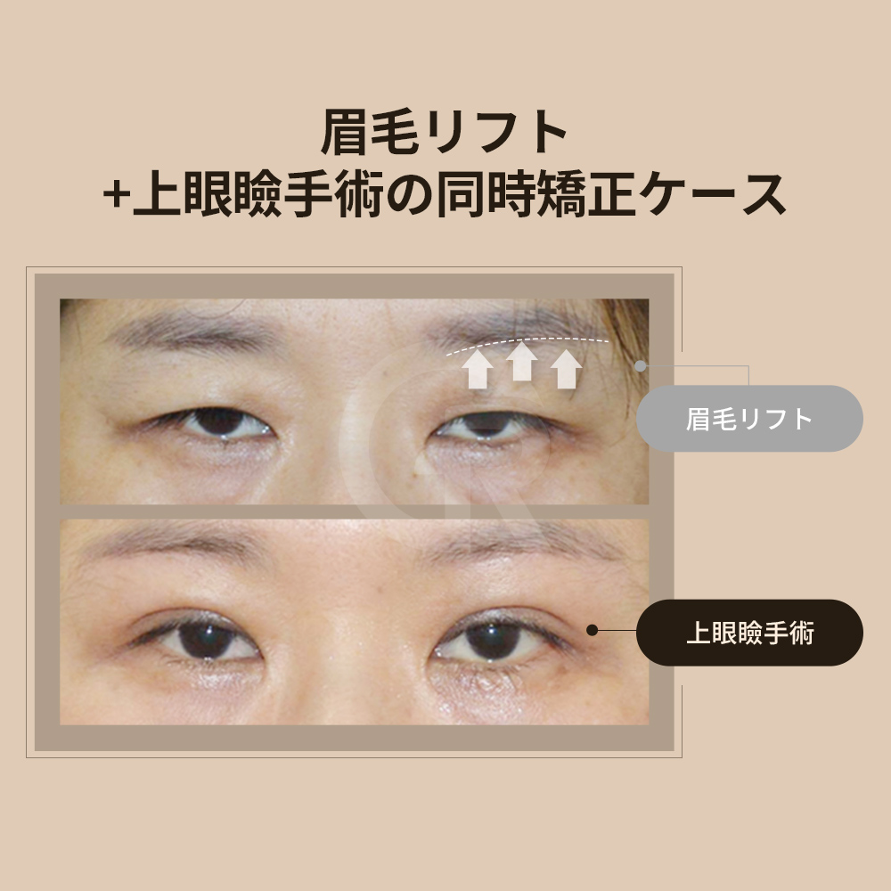 下眼瞼脂肪再配置は、脂肪除去よりも自然な結果をもたらします。