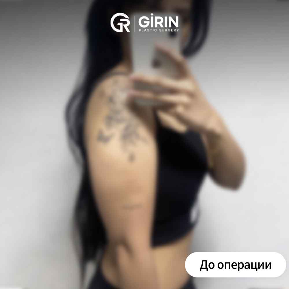 До и после липосакции рук в Корее