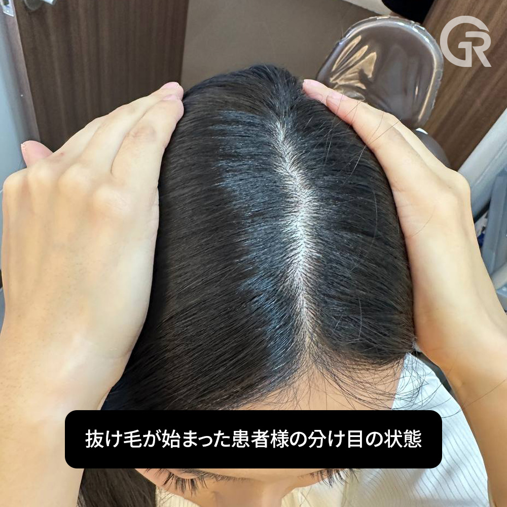 円形脱毛症が疑われた頭皮状態