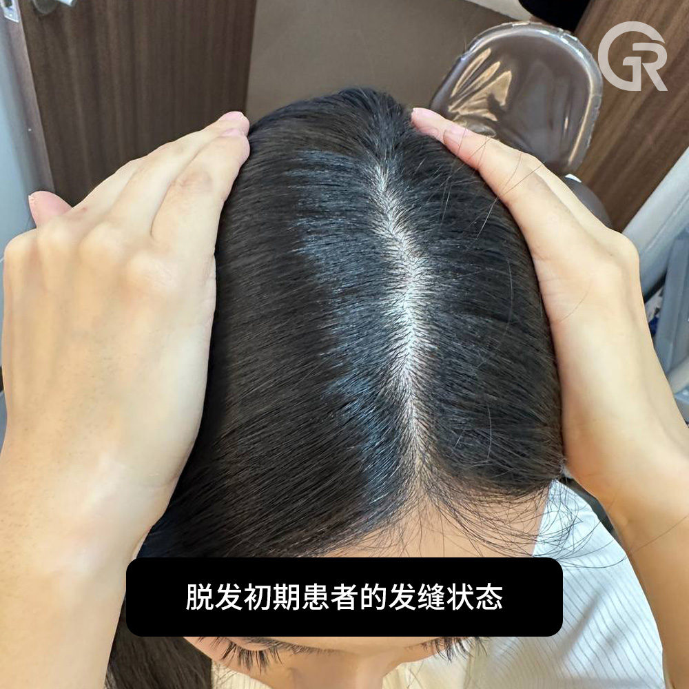 疑似斑秃的头皮表现