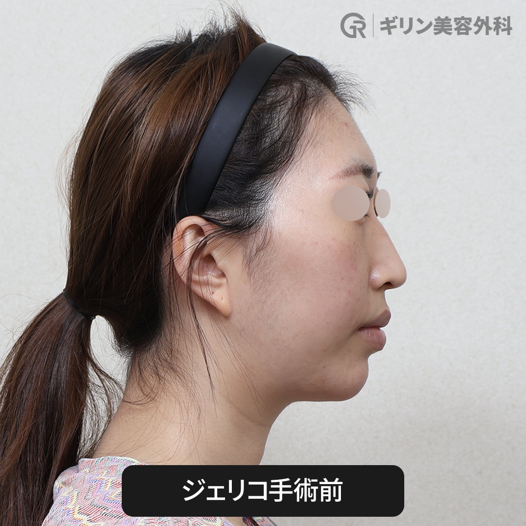 鼻フィラーと切開なし鼻整形の違いを比較