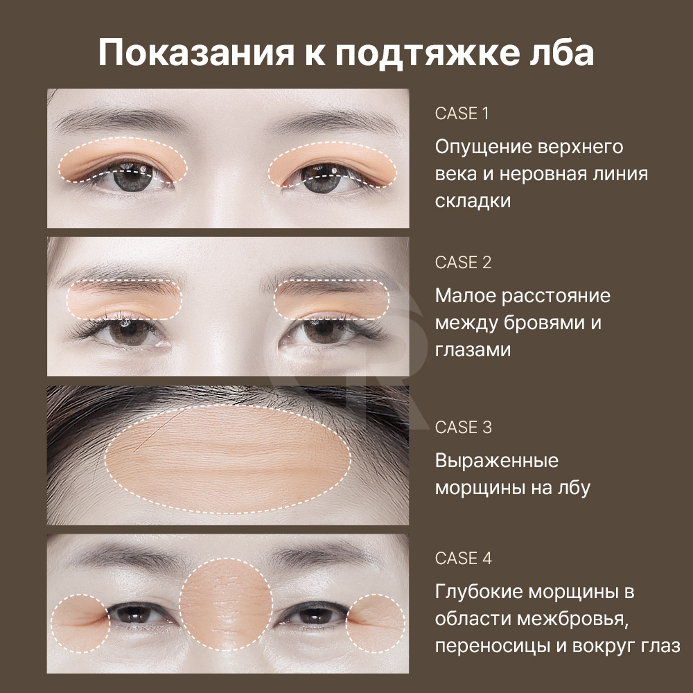 Верхняя блефаропластика удаляет лишнюю кожу, сохраняя естественную форму глаз.