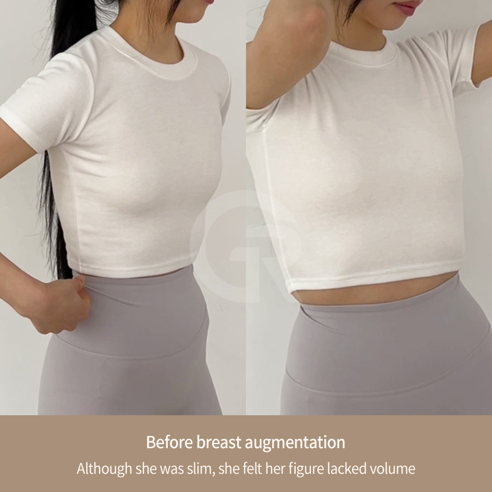 Understanding breast anatomy is an essential step before planning breast augmentation surgery.