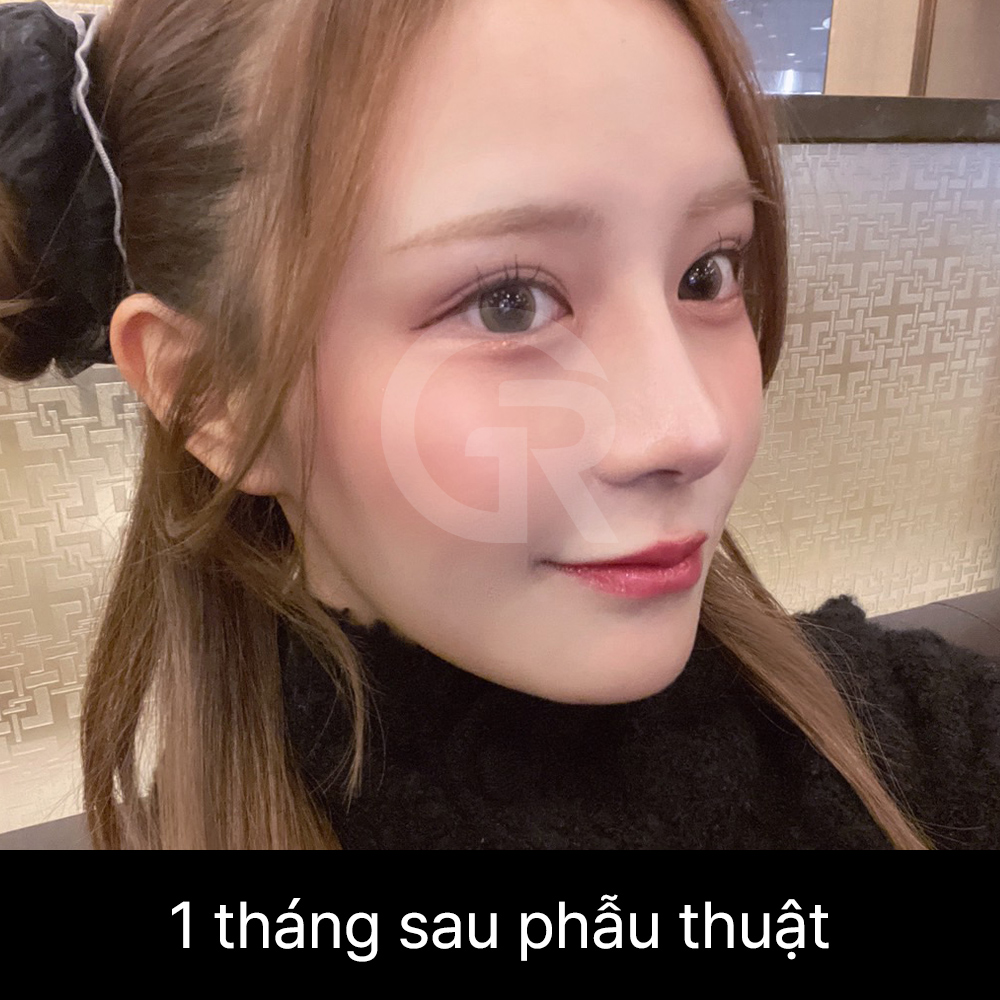 Ở mũi ngắn, nếu nâng đầu mũi quá mức, lỗ mũi có thể lộ nhiều hơn và khiến mũi trông hếch.