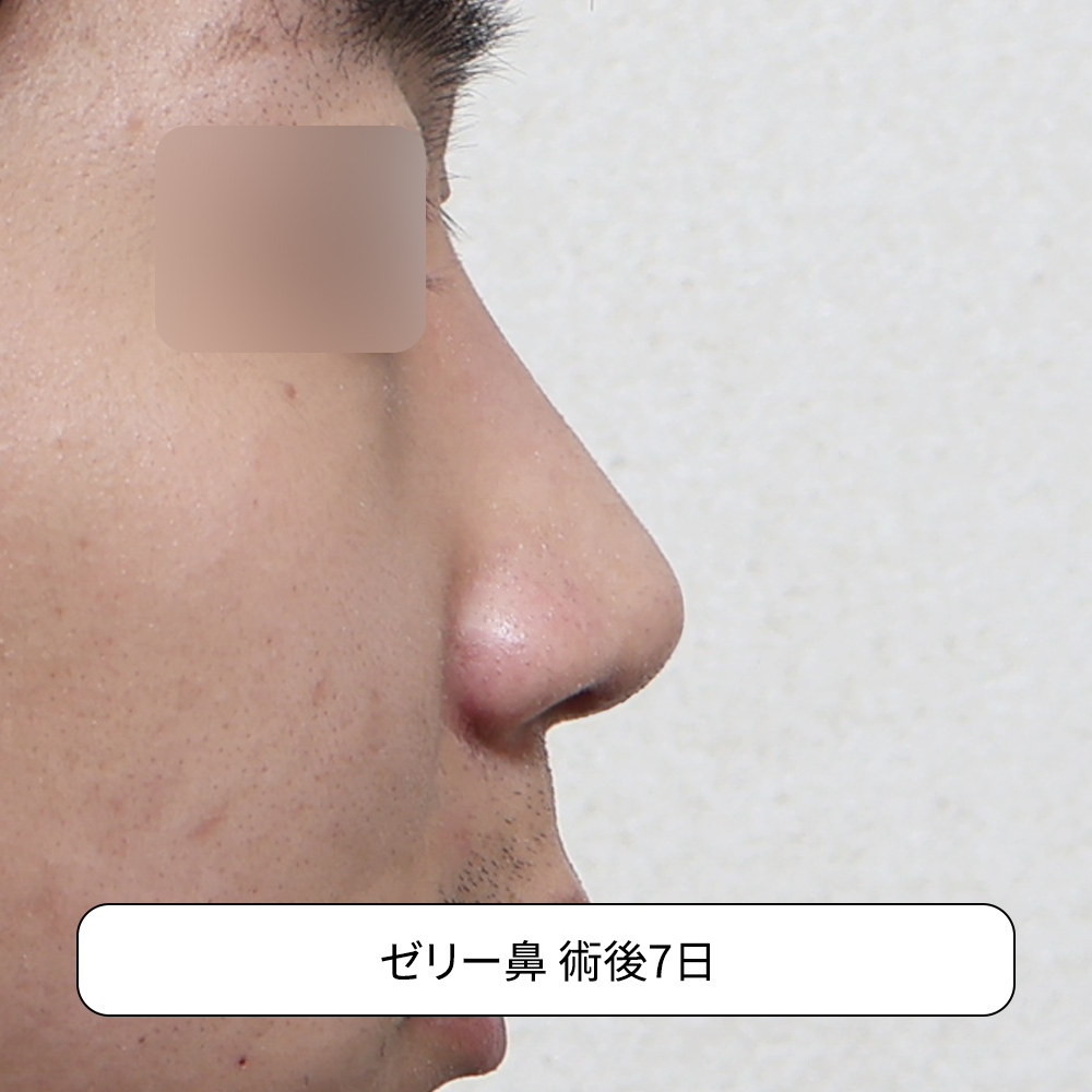 ハンプ鼻と団子鼻を同時に改善した男性複合鼻整形症例。