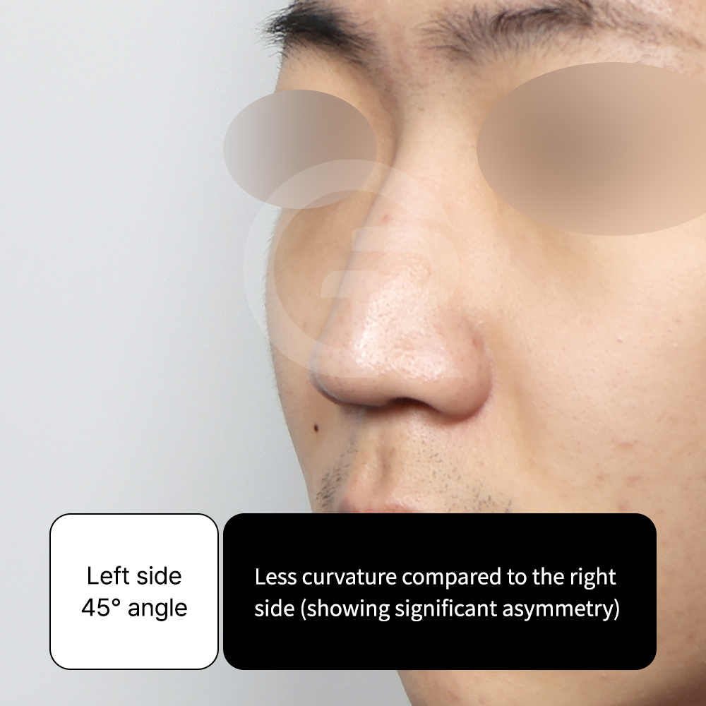 Implant-free rhinoplasty technique using autologous cartilage for structural stability and subtle refinement at GIRIN PLASTIC SURGERY.