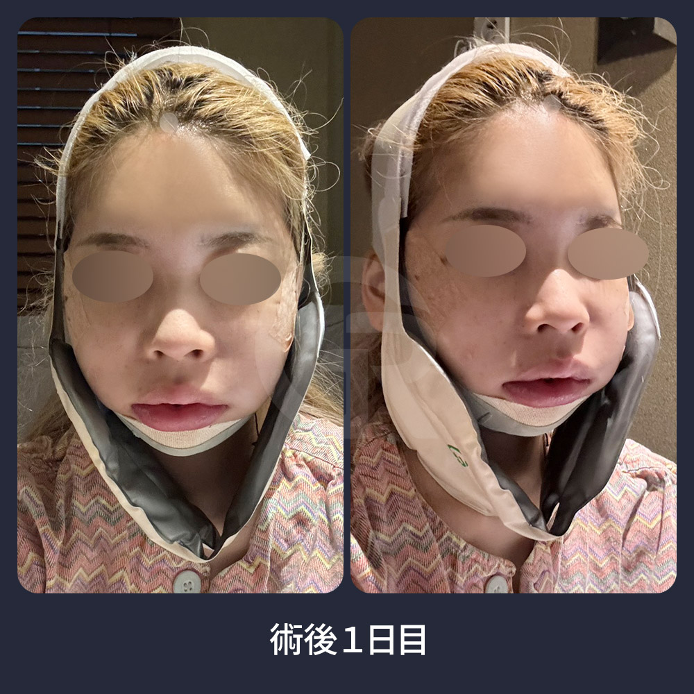 気道スペースが狭い場合、韓国ソウルのギリン美容外科では、顎骨を移動させる前に安全性を慎重に確認します。
