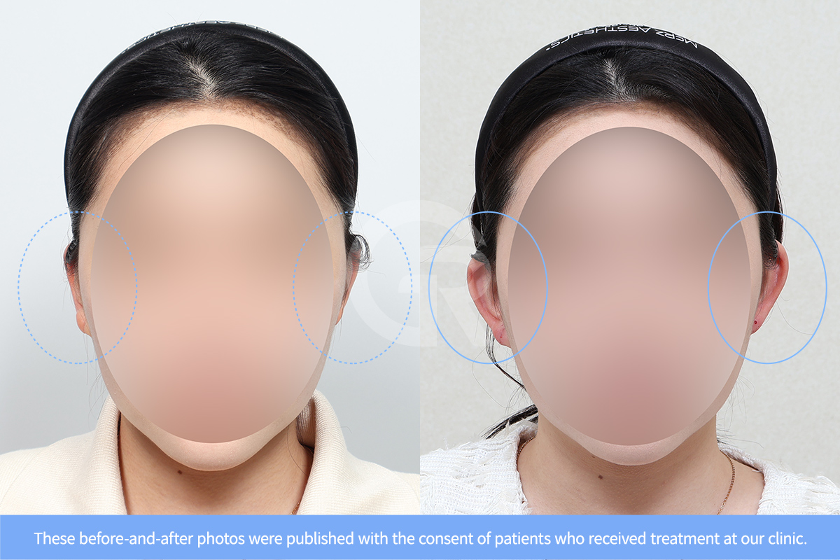 Natural ear angle achieved after lop ear surgery helps improve overall facial balance.