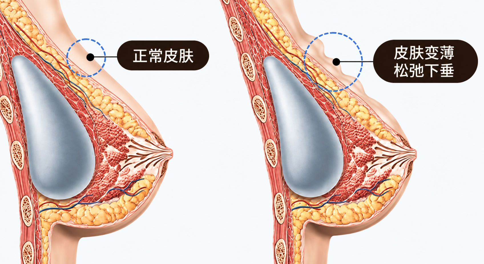 隆胸修复类型示意
