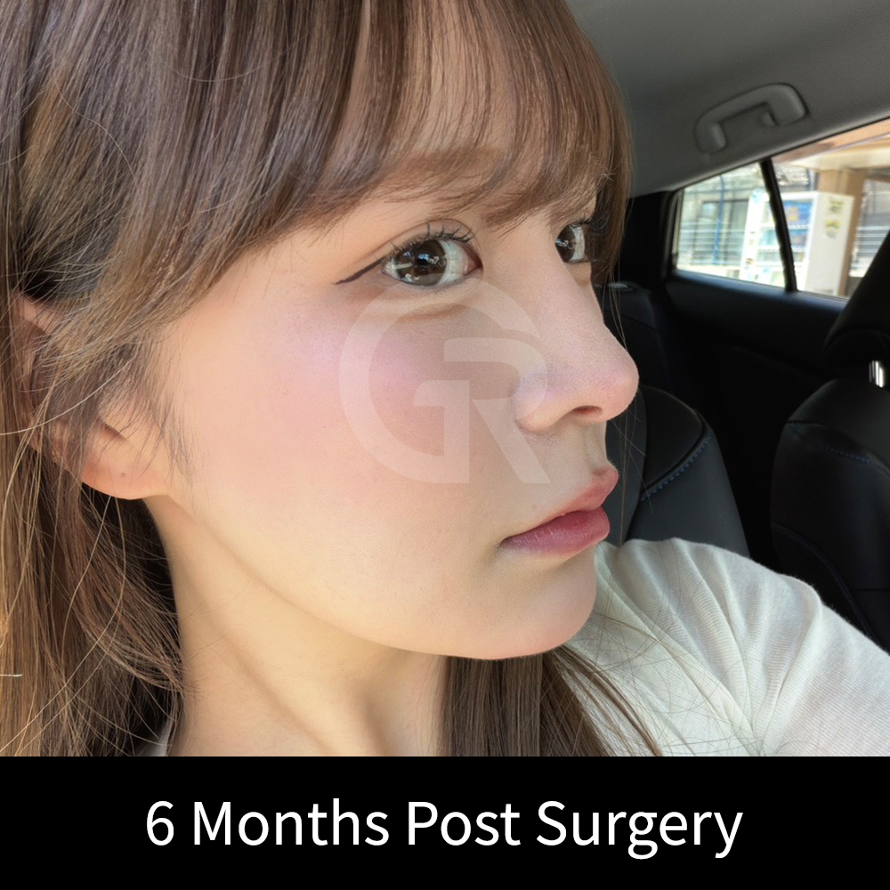 Nostril exposure, nasal tip projection, and columella position are important design details in short nose and bulbous nose correction.