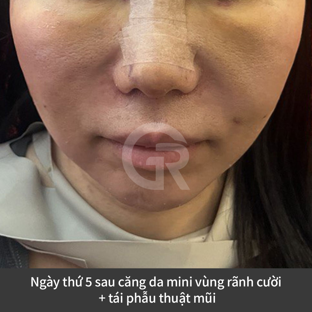 Review về cải thiện rãnh mũi má sâu và đường marionette tại Bệnh viện thẩm mỹ Girin Hàn Quốc, dành cho những ai quan tâm đến phẫu thuật trẻ hóa khuôn mặt.