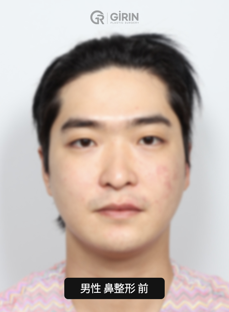 使用3D打印高端假体的精细鼻整形。