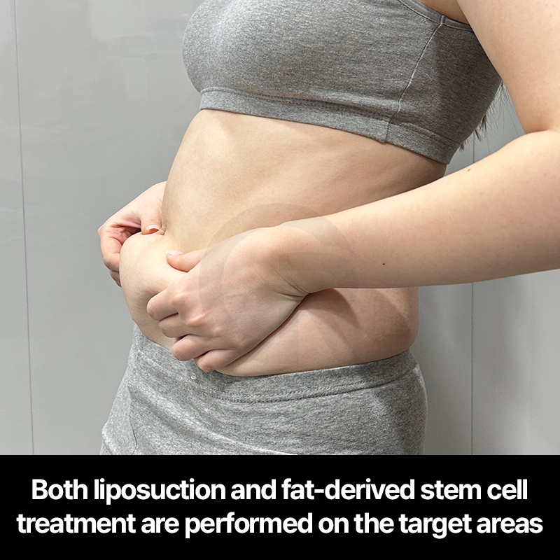 Non-cultured stem cell therapy in Korea involves same-day cell extraction and application without laboratory expansion.