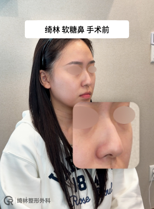 耳后软骨采集部位——微小切口，恢复后几乎看不见。