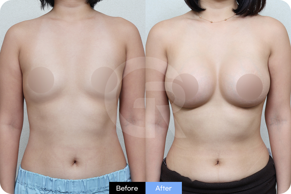 Girin Plastic Surgery Korea Breast Augmentation case 06 Front