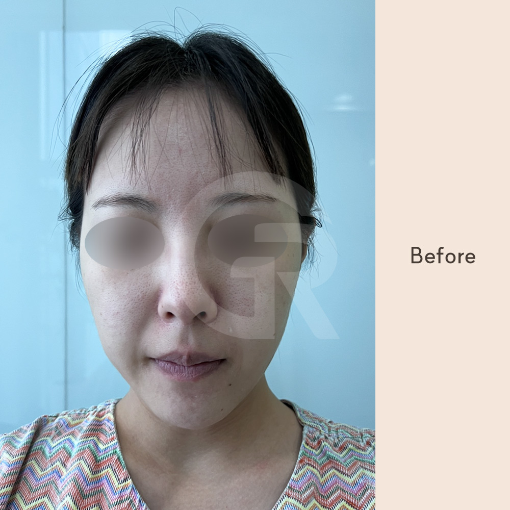 Double jaw surgery before and after in Korea showing clear improvement in facial balance, with repositioning of the maxilla and mandible to achieve a more harmonious profile.