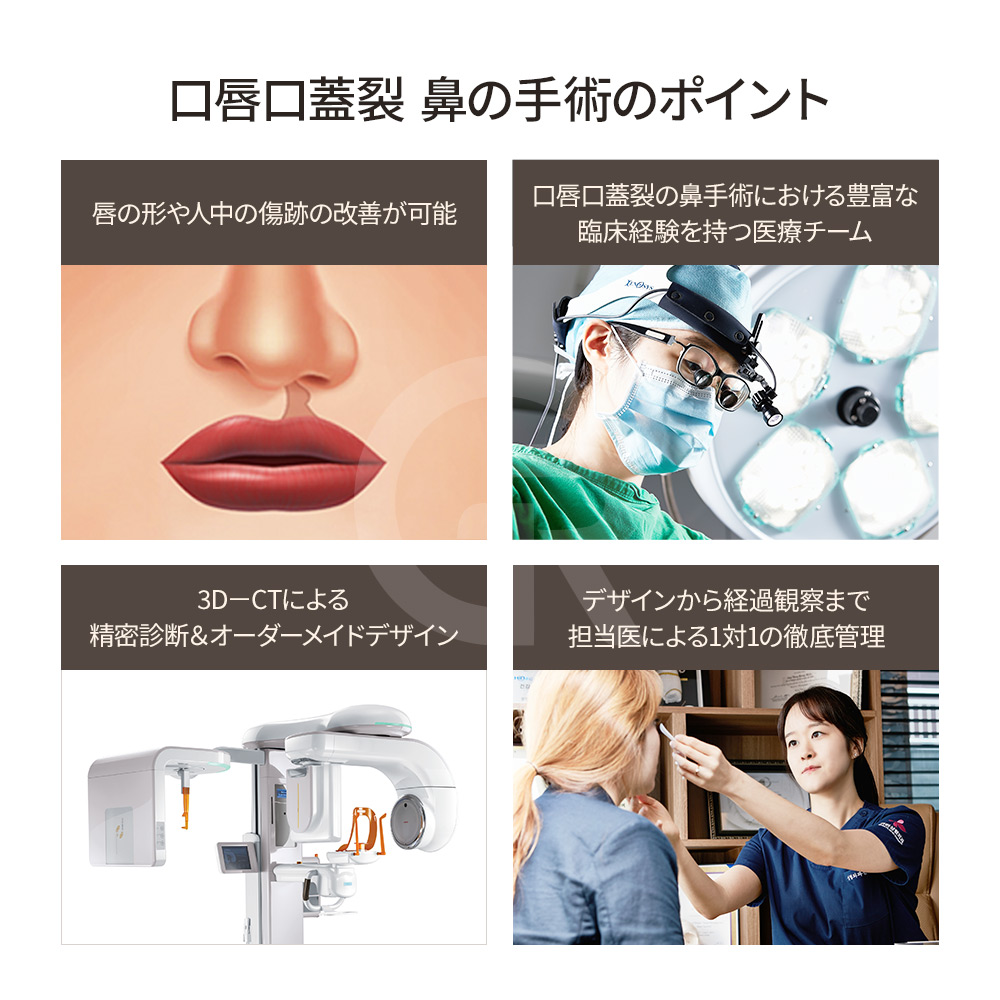 ギリン美容外科での鼻尖再建、口唇口蓋裂患者の構造修正例。