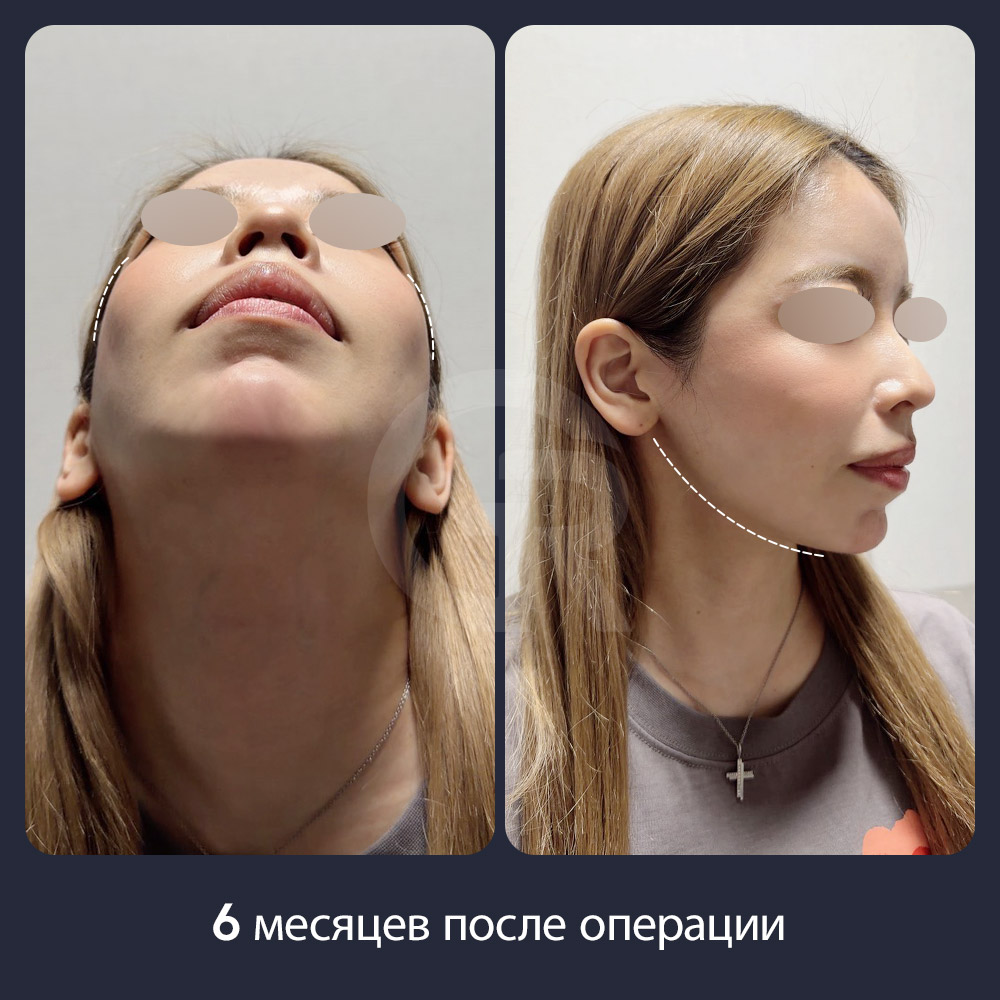 Подтяжка мышц под подбородком может улучшить соединение линии челюсти и линии шеи, если разделение мышц делает нижнюю часть лица менее четкой.