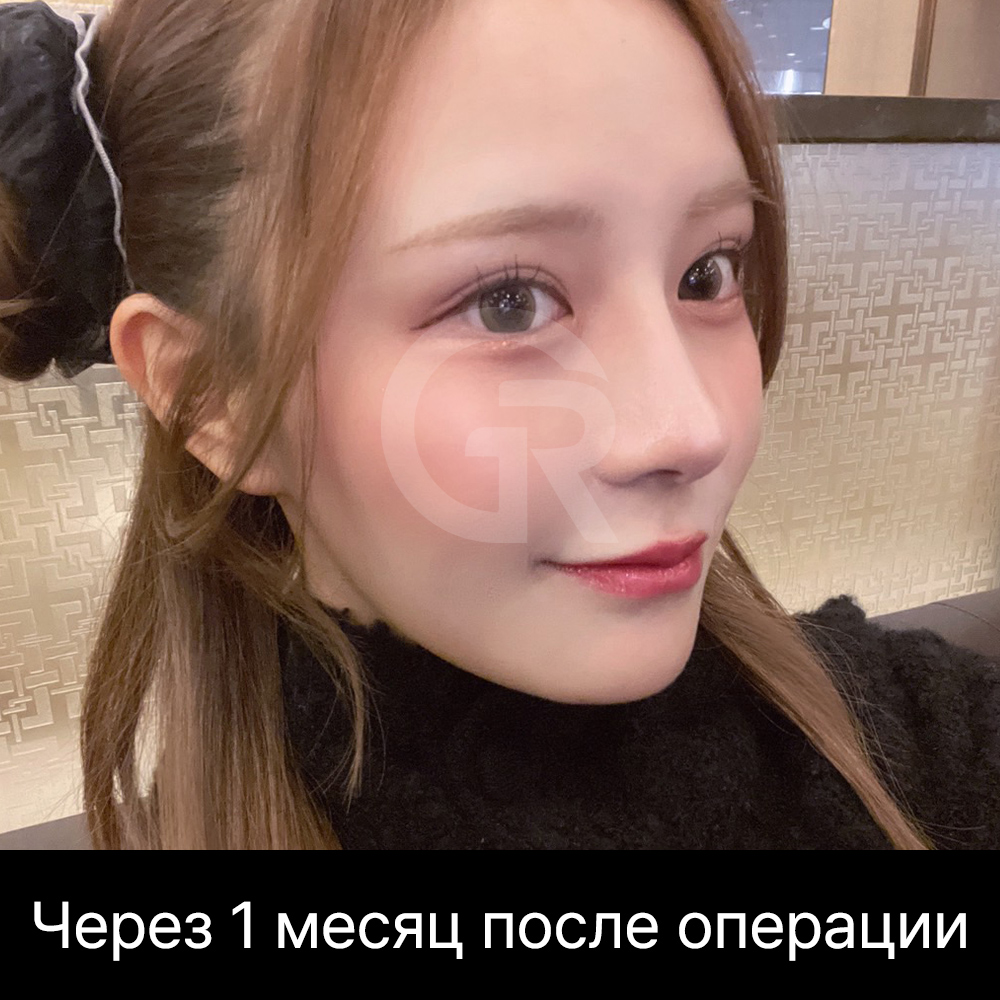 При коротком носе чрезмерное поднятие кончика может усилить видимость ноздрей и создать эффект вздернутого носа.