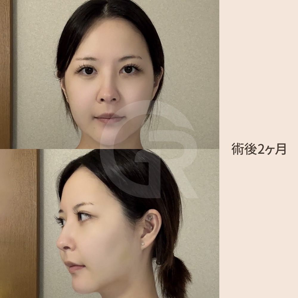ギリン整形外科における両顎手術と輪郭手術の違い