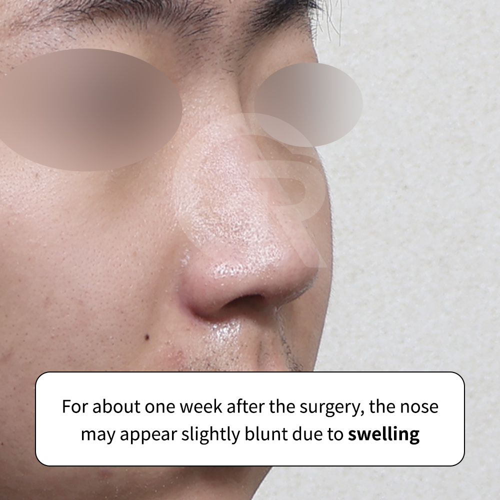 Preoperative structural analysis of nasal bone and cartilage segments in male rhinoplasty at GIRIN PLASTIC SURGERY.