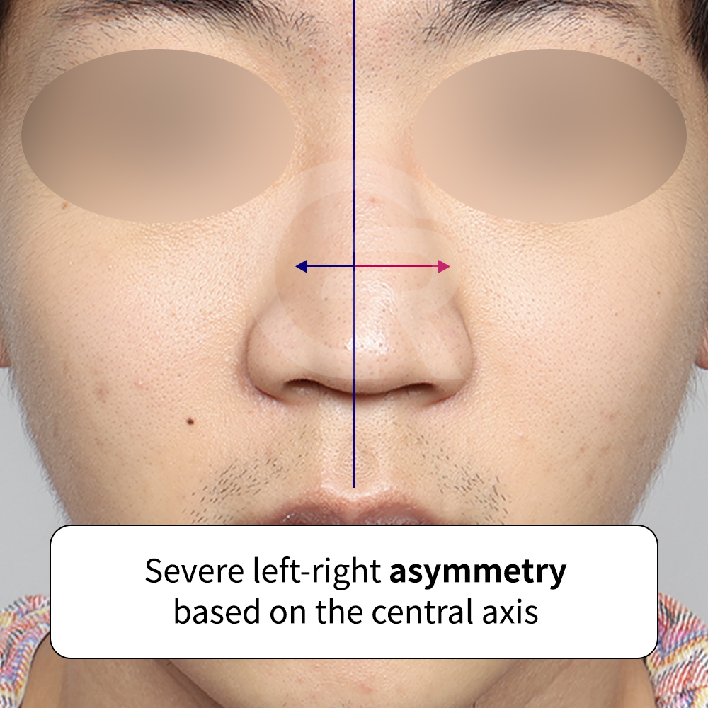 Male Jellyko rhinoplasty case at GIRIN PLASTIC SURGERY, a clinic known for structural rhinoplasty and natural-looking results in Korea.