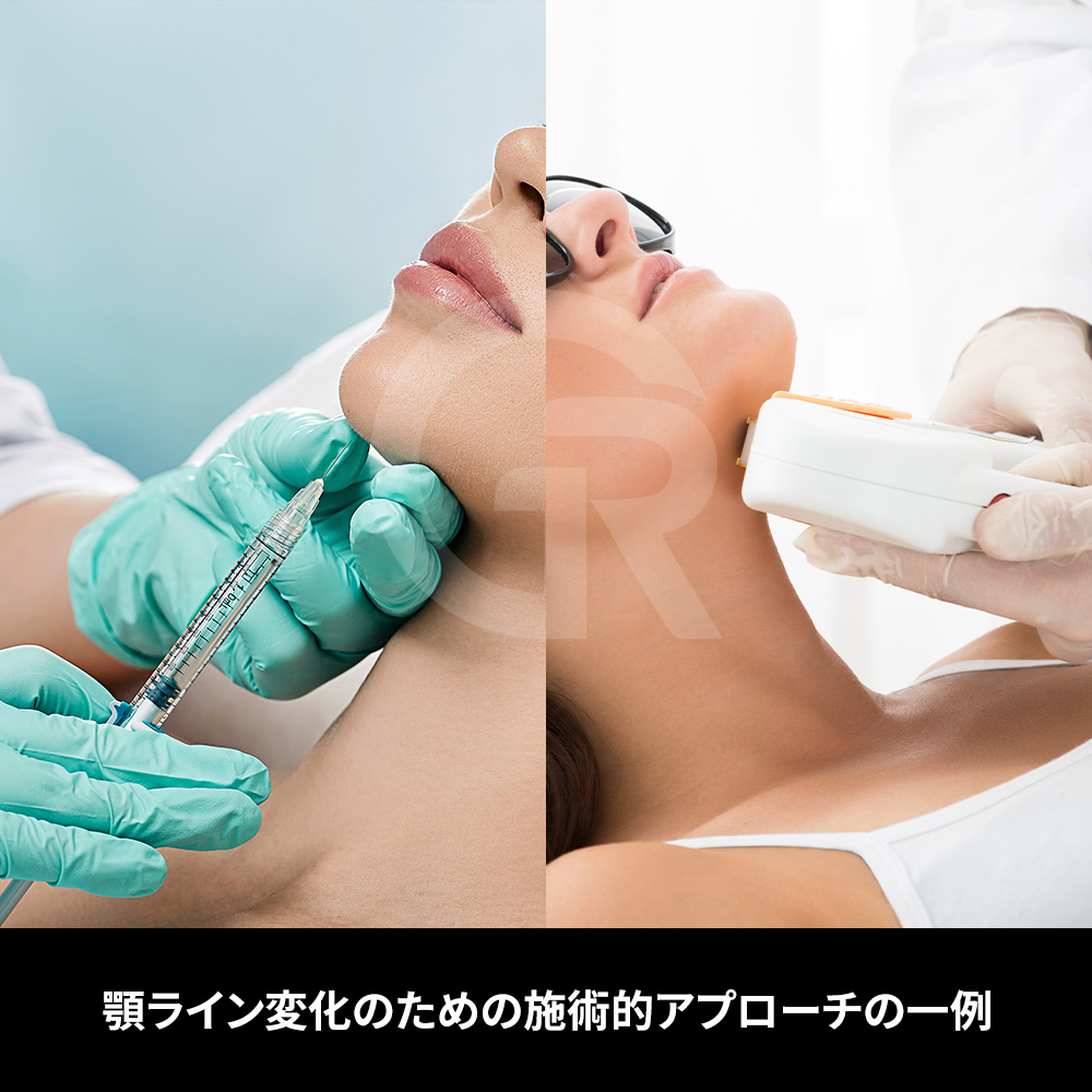 脂肪吸引と軟部組織再配置の組み合わせ
