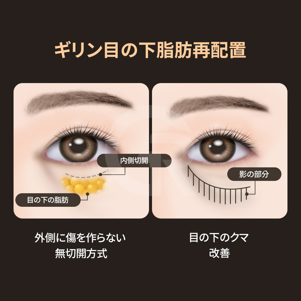 結膜側からのアプローチにより外部に傷跡は残りません。