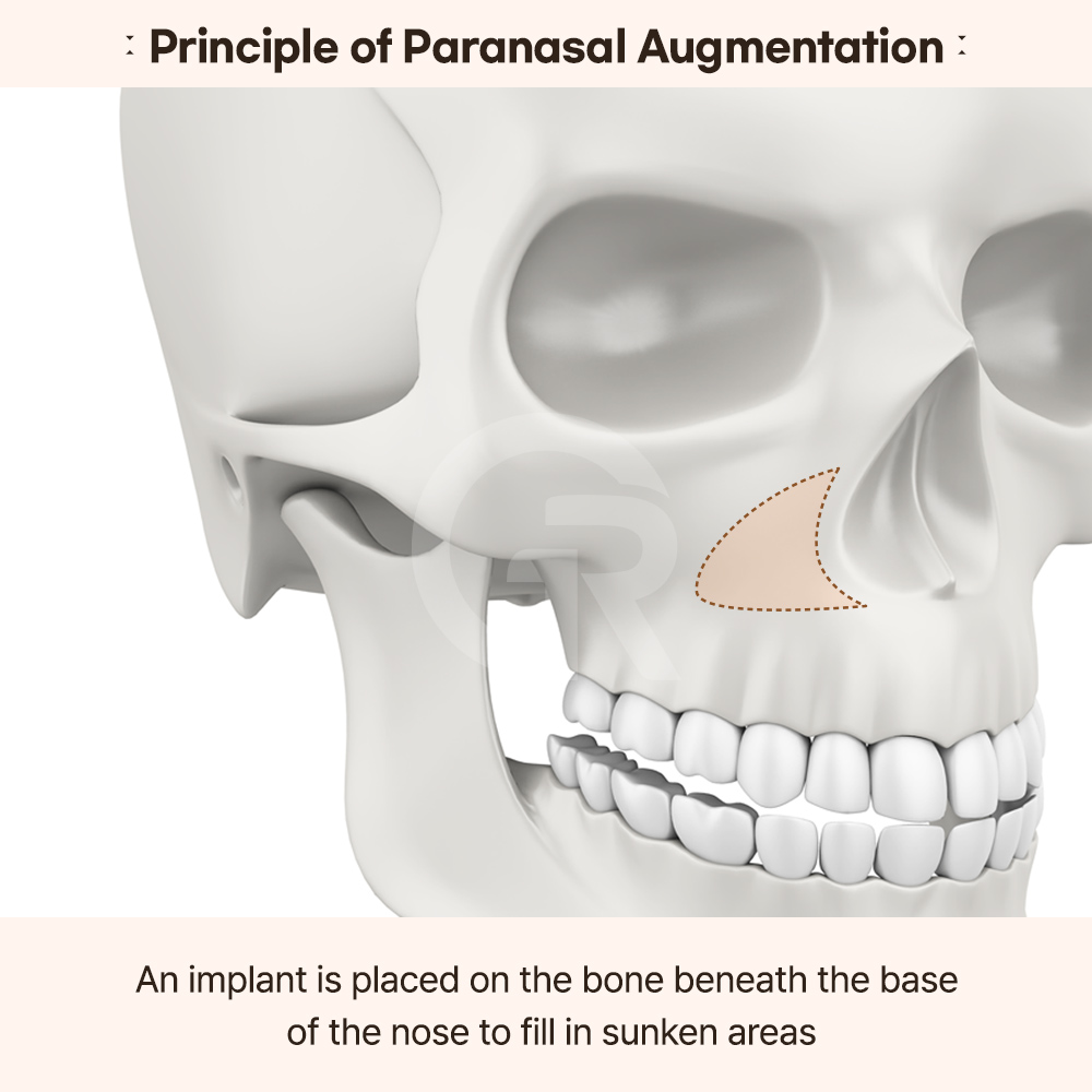 Customized implant design plays a critical role in achieving natural looking paranasal augmentation results.