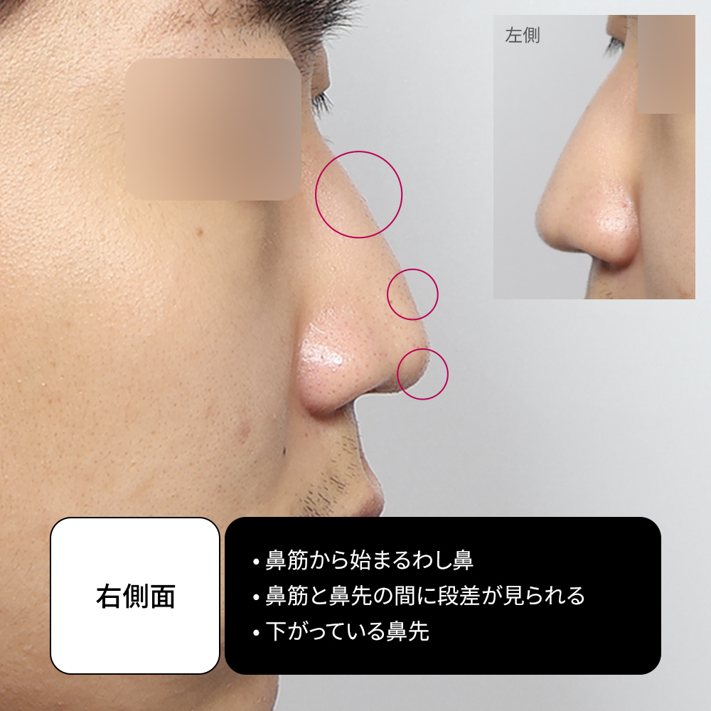 男性のハンプノーズ矯正手術のビフォーアフター比較。