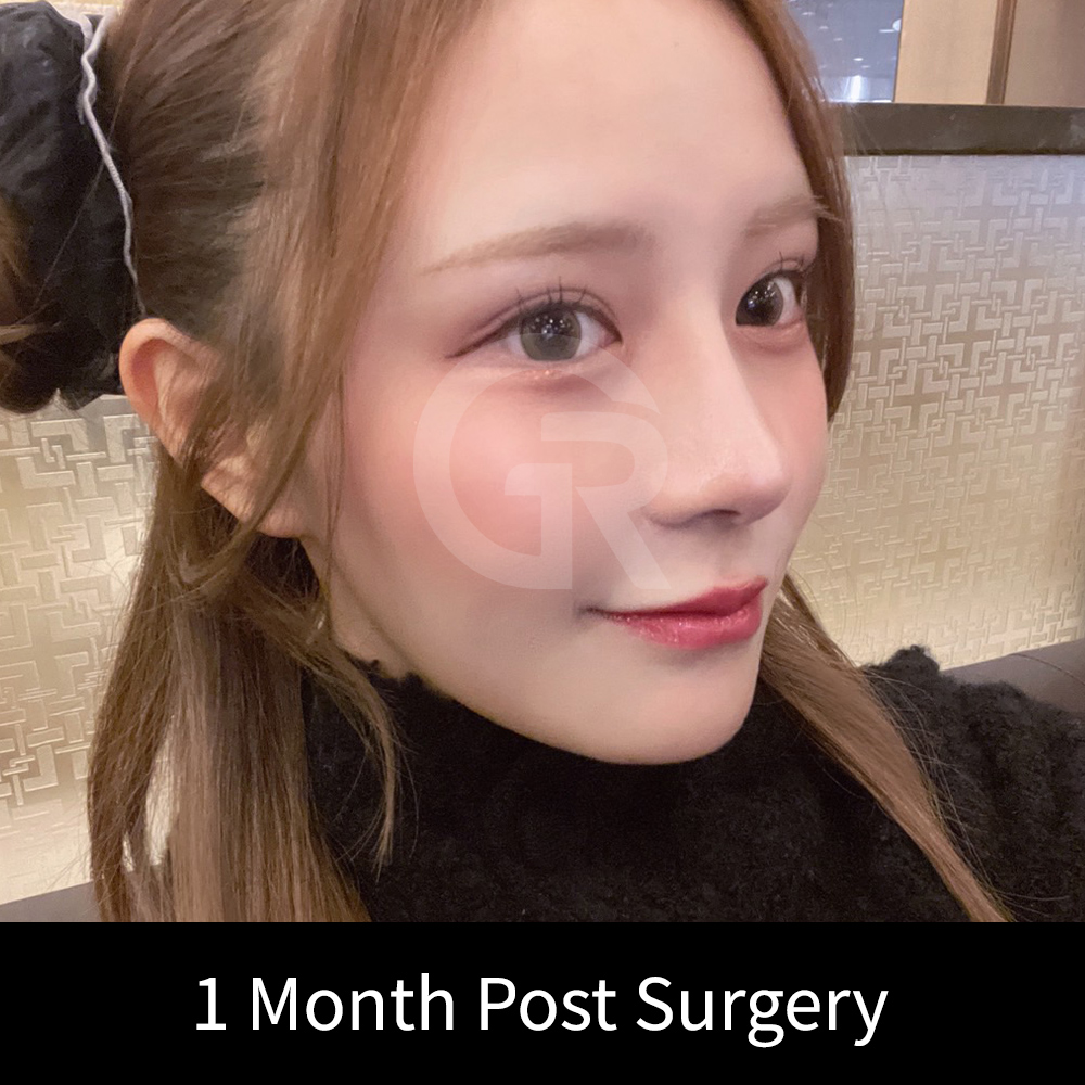 In short nose rhinoplasty, lifting the nasal tip too aggressively may increase nostril exposure and create an upturned appearance.