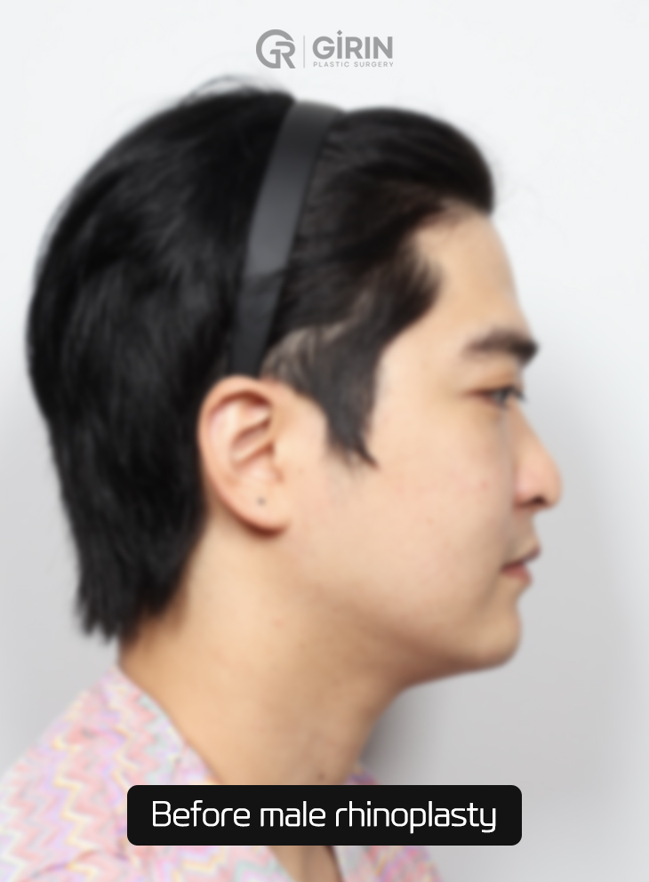 One of Korea’s most reputable clinics for male rhinoplasty.