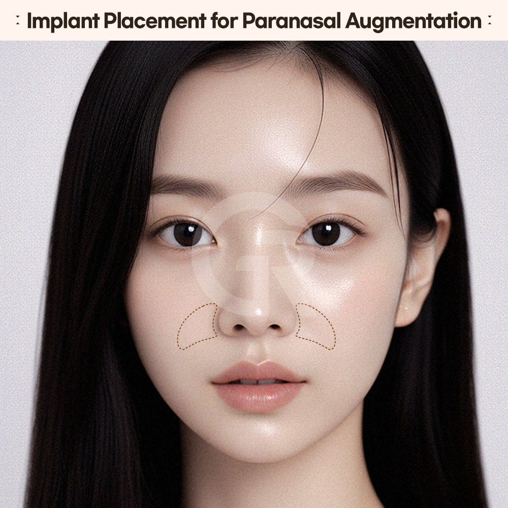 Proper subperiosteal implant placement ensures stability and long term structural support in the midface.