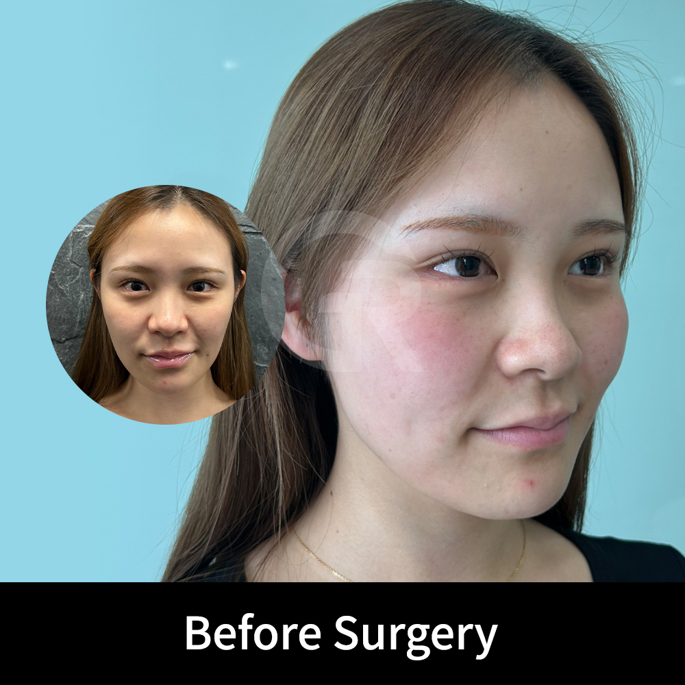 Winter nose rhinoplasty in Korea focuses not only on nasal height, but also on creating a soft, natural line that harmonizes with the face.