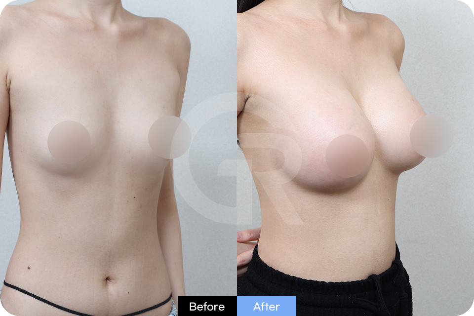 Girin Plastic Surgery Korea Breast Augmentation case 05 Half Side