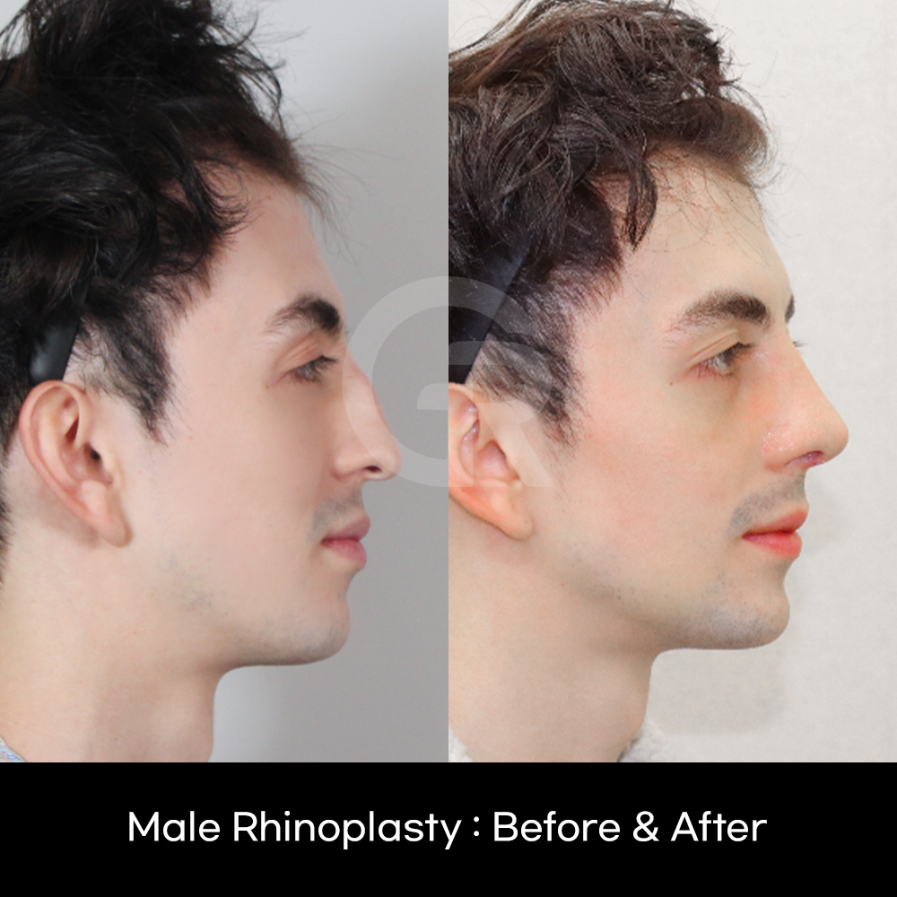 Natural rhinoplasty for Caucasian patients in Korea tailored to nasal structure, skin type, and facial proportions