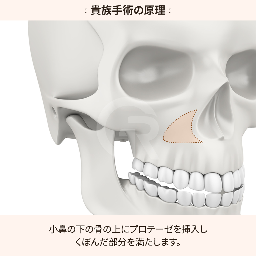 鼻翼基部のボリューム回復による顔のバランス改善